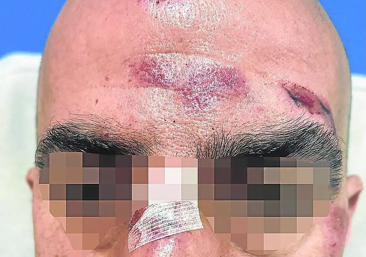 Sufrió la fractura de nariz tras ser atacado en la vía pública